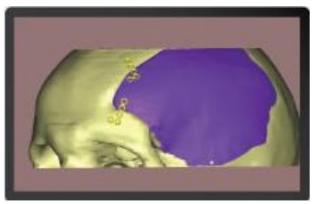 Inclusión de Implantes